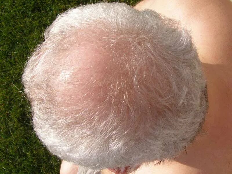 седые волосы на затылке. седая лысина. седина на затылке. седая лысина. седой затылок.