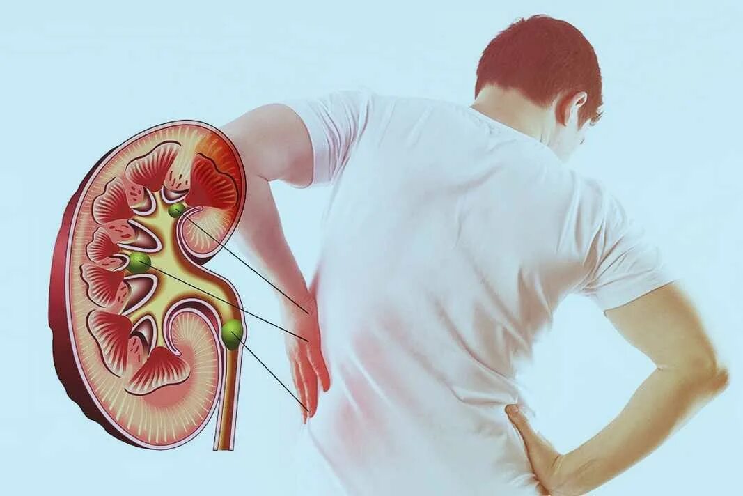 Почки после 50 лет. Мочекаменная болезнь почечная колика. Симптомы при поражении почек. Почки после 50 лет. Основные клинические проявления почечной недостаточности:.