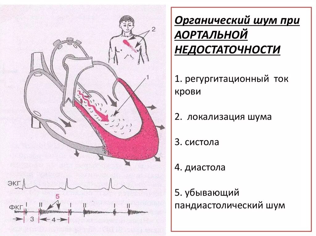 Аортальные шумы. Аортальные шумы. Аортальные шумы. Аортальная недостаточность диастолический шум. Аортальная недостаточность характеристика шума.