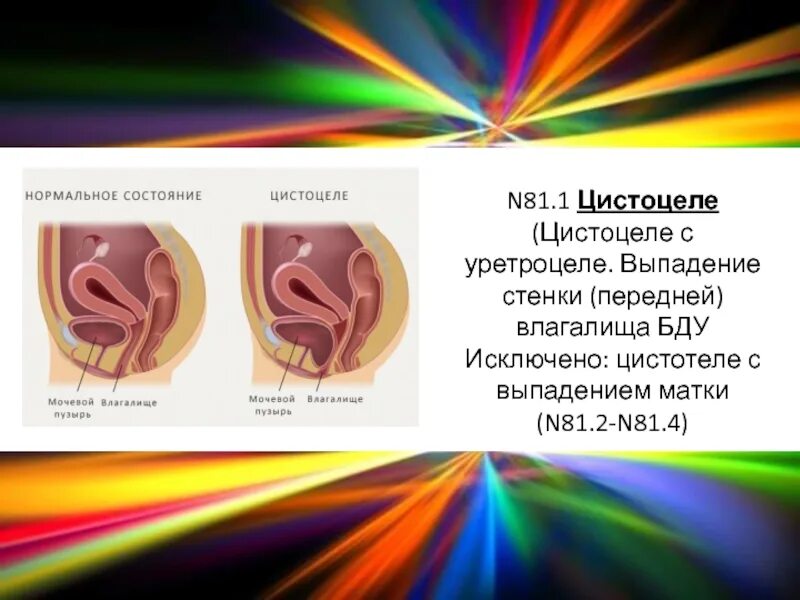 Упражнения для мышц тазового дна для женщин при недержании. Опущение мочевого пузыря у женщин. Пролапс передней стенки влагалища 2 степени. Пролапс мочевого пузыря. Цистоцеле мочевого пузыря.