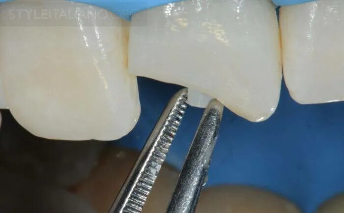 Dentoclic штифты стекловолоконные. Стекловолоконные штифты фиксация. Стекловолоконные штифты фиксация. Стекловолоконный штифт м1. Стекловолоконный штифт с пломбой.