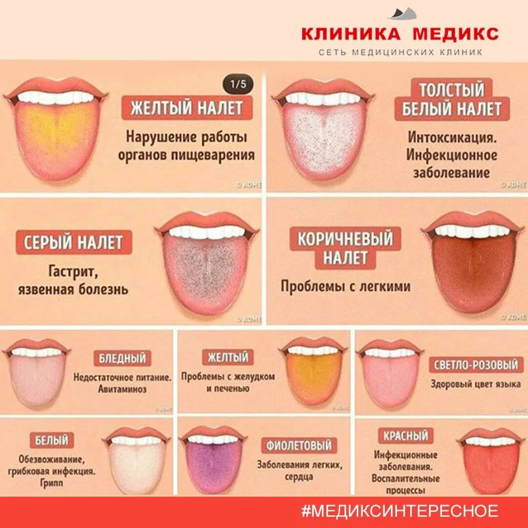 Вкус еда во рту причины. По цвету языка определить болезни. Цвет языка о чем говорит.