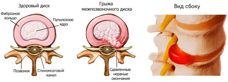 Можно ли греть грыжу поясничного. Грыжа позвоночника фиброзное кольцо. Грыжа позвоночника пульпозное ядро. Фиброзное кольцо межпозвоночного диска. Грыжа межпозвоночного диска разрыв фиброзного кольца.