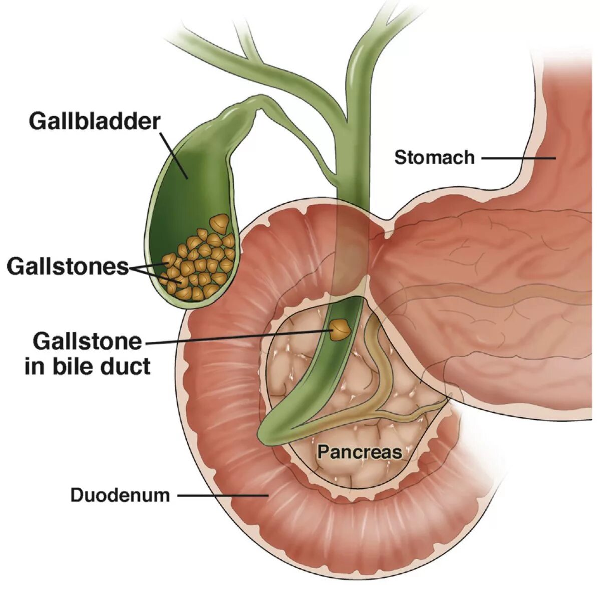 В поджелудочной бывают камни. Желчный пузырь анатомия человека. Анатомия расположения желчного пузыря. Камень в протоке желчного пузыря. Желчнокаменная болезнь анатомия.