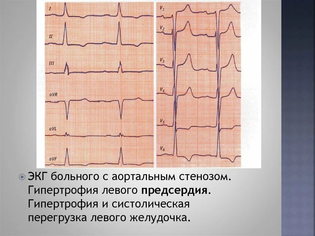 Гипертрофия левого предсердия левого желудочка. Гипертрофия левого предсердия на ЭКГ. Гипертрофия предсердий на ЭКГ. Гипертрофия правого предсердия на ЭКГ. ЭКГ при систолической перегрузки левого желудочка.