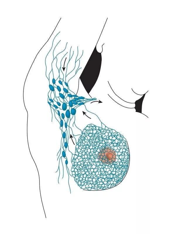 Сосуды молочной железы. Расширенные сосуды в молочной железе. Вены молочной железы женщины. Болят лимфоузлы в грудной железе. Аксиллярная лимфаденопатия молочной