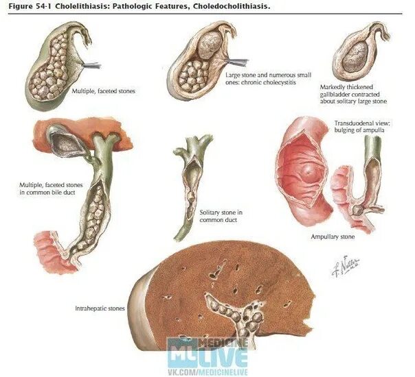 Холецистолитиаз желчного. Желчнокаменная болезнь холецистолитиаз. Холецистолитиаз желчного пузыря что это. ЖКБ камни желчного пузыря. Хронический холелитиаз.