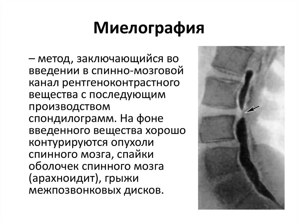 Мрт миелография спинного мозга. Миелография позвоночника что это такое. Кт миелография позвоночника. Поясничного отдела позвоночника + миелография. Опухоли введение