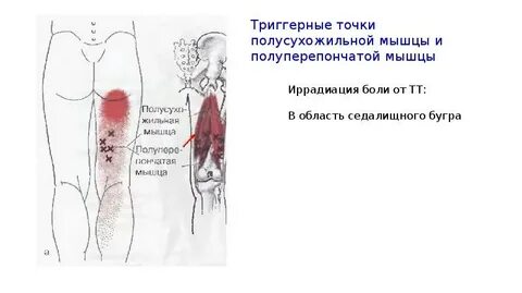 Область седалищного бугра