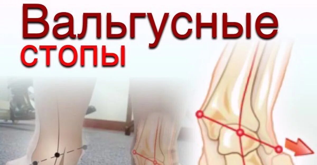 Деформация стопы. Вальгусная деформация голеностопного сустава. вальгус вальгус плоскостопие. плоско вальгусное плоскостопие. плосковальгусная деформация стопы.