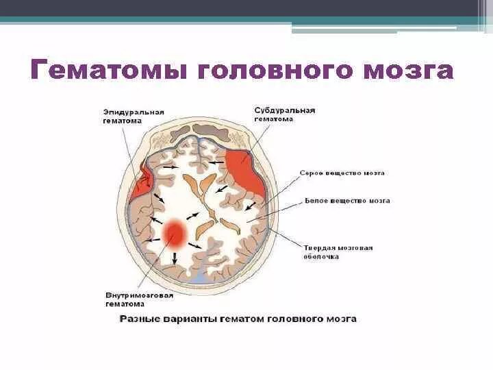 Эпидуральная субдуральная и внутримозговая гематома. Гематомы головного мозга классификация. Внутричерепные гематомы классификация. Расположение гематом головного мозга классификация. Гематома в стадии организации