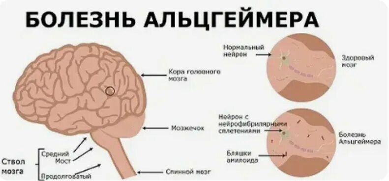 Мозг слабоумие. Причины развития болезни Альцгеймера. Механизм развития болезни Альцгеймера. Болезнь Альцгеймера симптомы причины. Болезнь Альцгеймера причины.