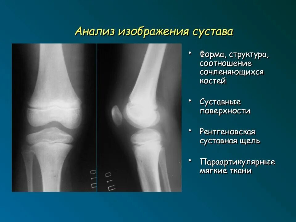 Какой сустав изображен. Рентгеновская суставная щель. Параартикулярные мягкие ткани коленного сустава. Параартикулярные обызвествления мягких тканей.