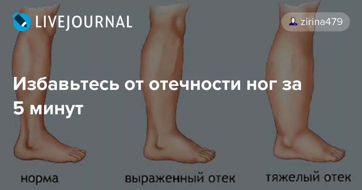 Избавление от отеков на ногах. Упражнения от отечности ног при отеках.