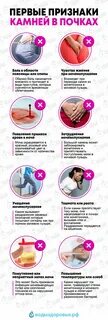 Первые признаки камней в почках Лечение, Здоровье, Товары для здоровья