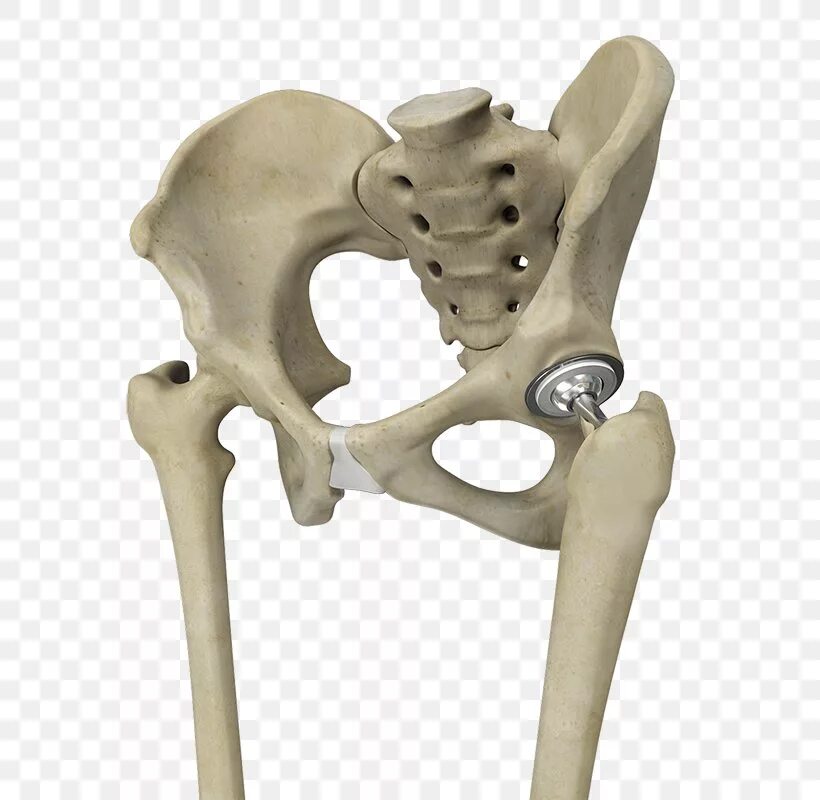 Скелет человека тазобедренный сустав. Тазобедренный сустав и бедренная кость. Тазобедренный эндопротез Зиммер. Эндопротезирование вертлужной впадины.