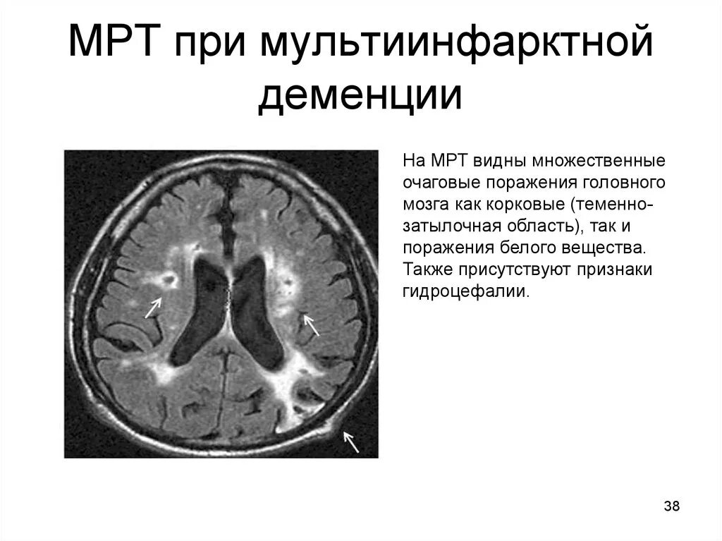 Множественные очаговые изменения мозга. Сосудистая деменция на кт. Кт при деменции. Сосудистая деменция мрт. Мрт головного мозга при сосудистой деменции.