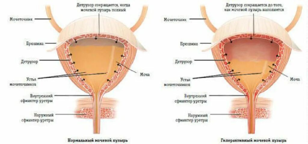 У мужчин не выходит моча у. Мочевой пузырь. Детрузор мочевого. Гиперактивность детрузора. Мышца детрузор мочевого пузыря.