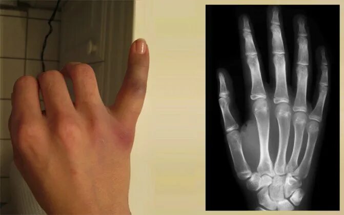 Трещина в кисти. Периостит пальца кисти рентген. Перелом пястной кости 5 пальца. Перелом средней фаланги безымянного пальца. Остеотомия пястной кости.