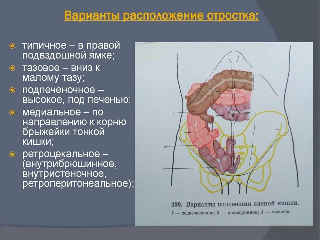 Синтопия подвздошной кишки. Локализация острого аппендицита. Расположение аппендицита. Расположение аппендикса. Правая подвздошная кишка