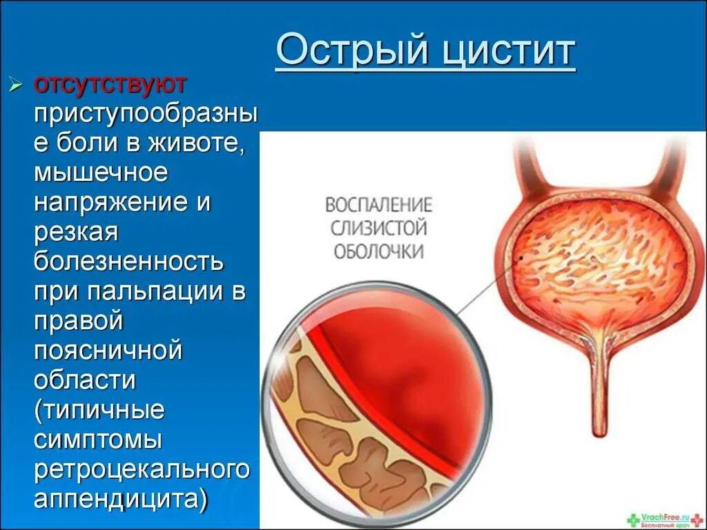 Воспаление мочевого пузыря.