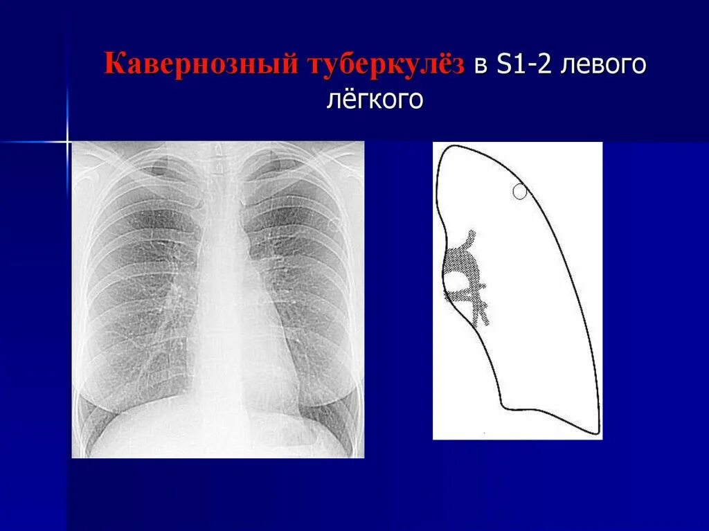 S6 в легких в правом легком. Кавернозный туберкулез s1-2. Легкое s1 s2 левого легкого. Инфильтративный туберкулез s1-2 левого легкого. Инфильтративный туберкулёз s1-2 левого легкого s6 правого легкого.