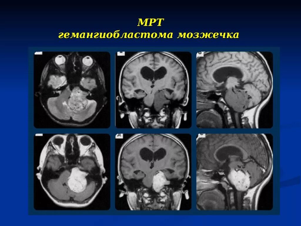 Опухоль головного мозга гемангиобластома. Опухоль червя мозжечка. Опухоль червя мозжечка мрт. Мозжечковая опухоль