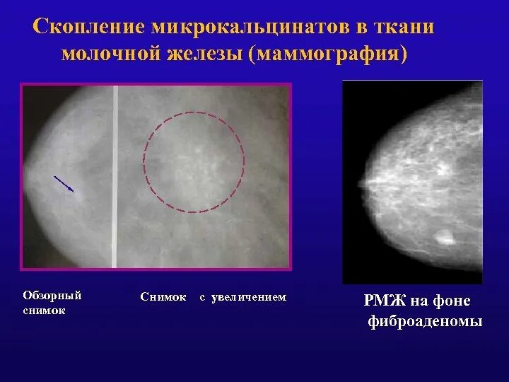 Округлые кальцинаты. Обызвествленная фиброаденома молочной железы маммография. Фиброаденома на УЗИ И маммографии. Фиброаденома молочной железы маммография. Кальцинаты молочной железы на маммографии.