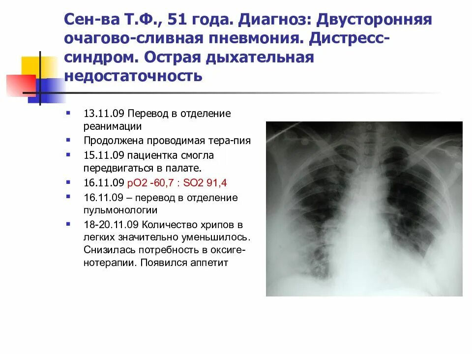 В 19 лет диагноз. Двусторонняя пневмония симптомы. Двухстороннее воспаление лёгких. Двустороннее воспаление легких симптомы. Двусторонняя пневмония легкие.