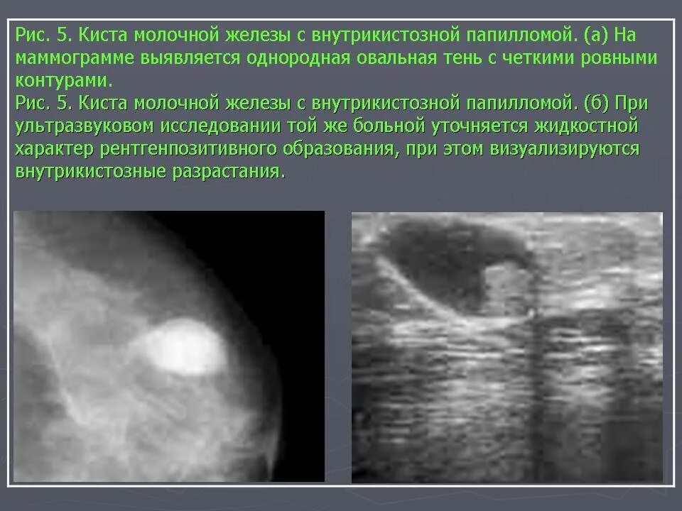Содержимое кисты молочной. Фиброаденома молочной опухоли. фиброаденома молочной железы маммография. фиброаденома мол жел узи. киста маммография снимки.