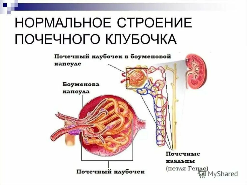 Гломерулонефрит почечный клубочек. Клубочки почек гломерулонефрит. Строение почки клубочки канальцы. Строение клубочка почки анатомия. Поражение клубочков почек