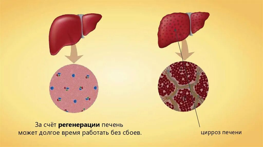 Повреждение клеток печени. Регенерация клеток печени. Регенерация печени у человека. Патологическая регенерация печени.