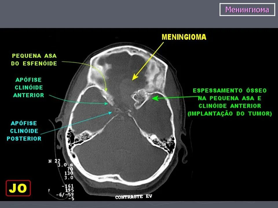 Обызвествление менингиомы. Диагноз менингиома формулировка. Боли при менингиоме. Краниофарингиома гипофиза кт. Микрокистозная менингиома.