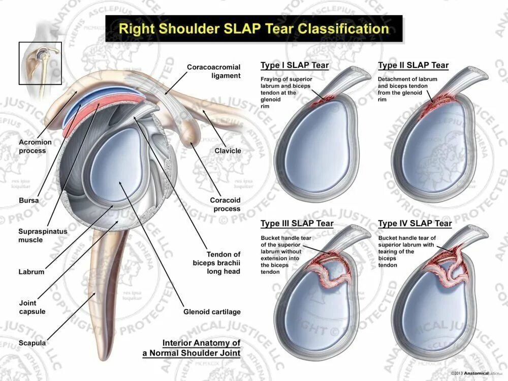 Классификация slap повреждения. Slap повреждение плечевого сустава классификация. Slap синдром плечевого сустава.