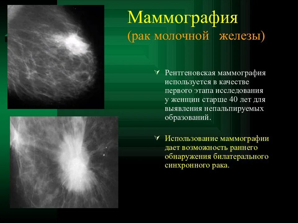 Маммография молочных желез объемное образование. Опухоль молочной железы. Онкология молочной железы. Опухольмолочныйжелезы. Злокачественная опухоль лечится