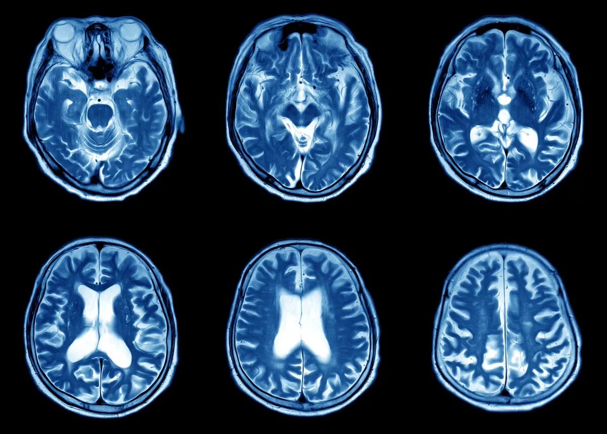 Долголетие мрт. Кт томограмма головного мозга. Компьютерная томография кт головного мозга. Мрт магнитно-резонансная томография головного мозга. MRI головного мозга.