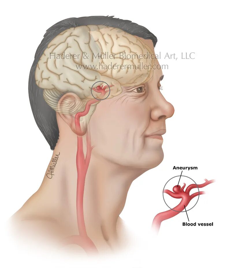 Аневризма ВСА головного мозга. Мешотчатая аневризма сонной артерии шеи. Аневризма сонной артерии головного мозга. Аневризма сосудов мозга. Расширение сосудов головы