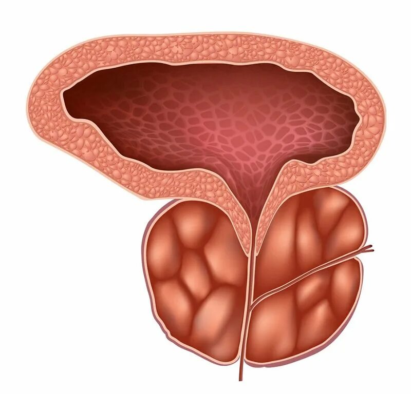 Доброкачественная гиперплазия предстательной железы. Аденома предстательная железа у мужчин. Воспаление аденомы простаты.