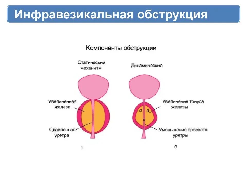 Дгпж в урологии. Доброкачественная гиперплазия предстательной железы этиология. Доброкачественная гиперплазия предстательной железы патогенез. Этиология патогенез доброкачественной гиперплазии простаты. Инфравезикальная обструкция.