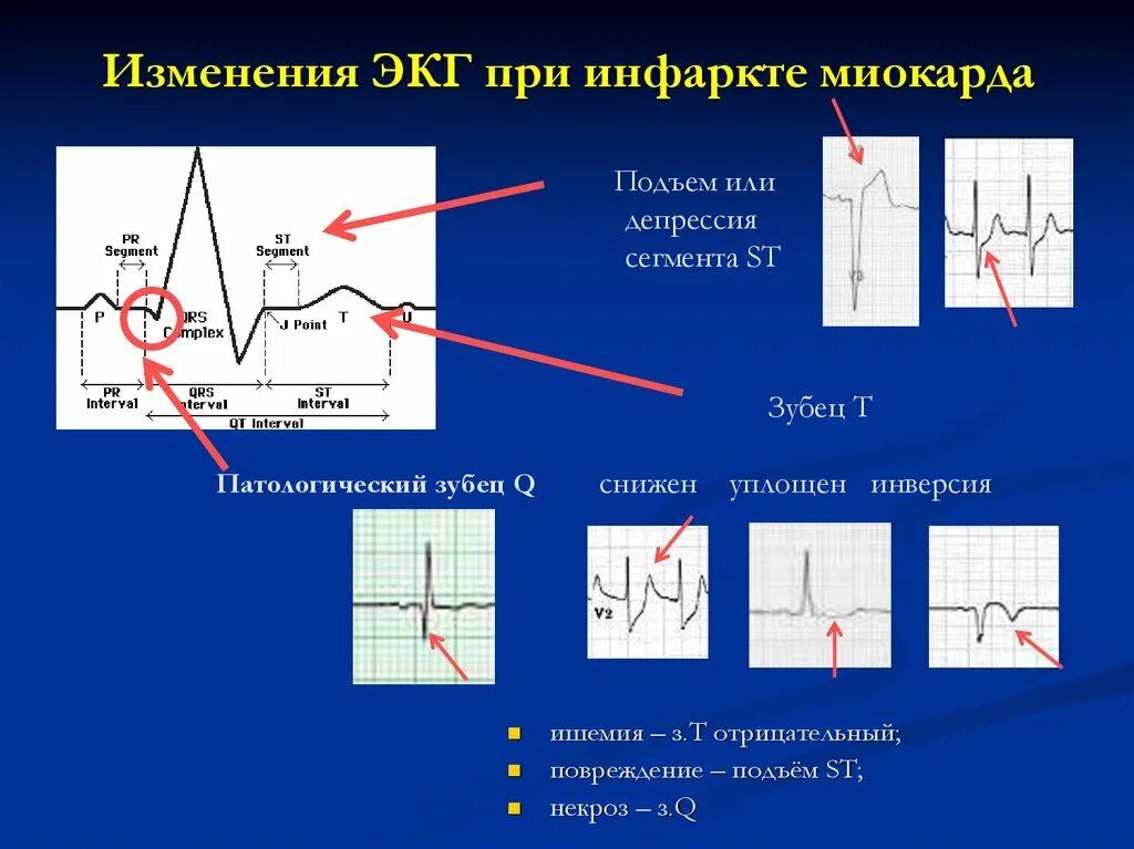 Изменение зубца q. ЭКГ при q инфаркте миокарда. Изменения на ЭКГ при инфаркте. Сегмент St острый инфаркт миокарда. Депрессия сегмента St на ЭКГ при инфаркте миокарда.