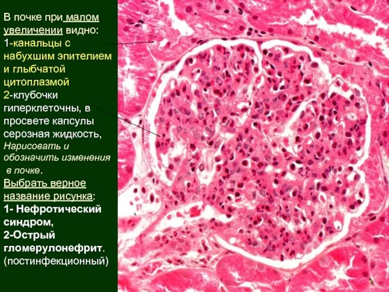 Интракапиллярный гломерулонефрит макропрепарат. Гломерулонефрит гистология. Гломерулонефрит патанатомия. Экстракапиллярный гломерулонефрит морфология. Хронический диффузный гломерулонефрит