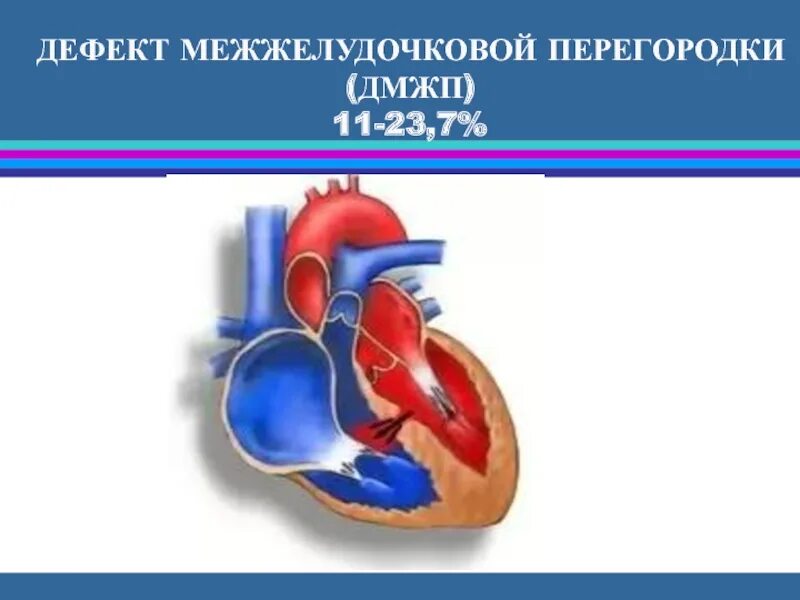 Дмжп 3 мм. Дмжп 3 мм