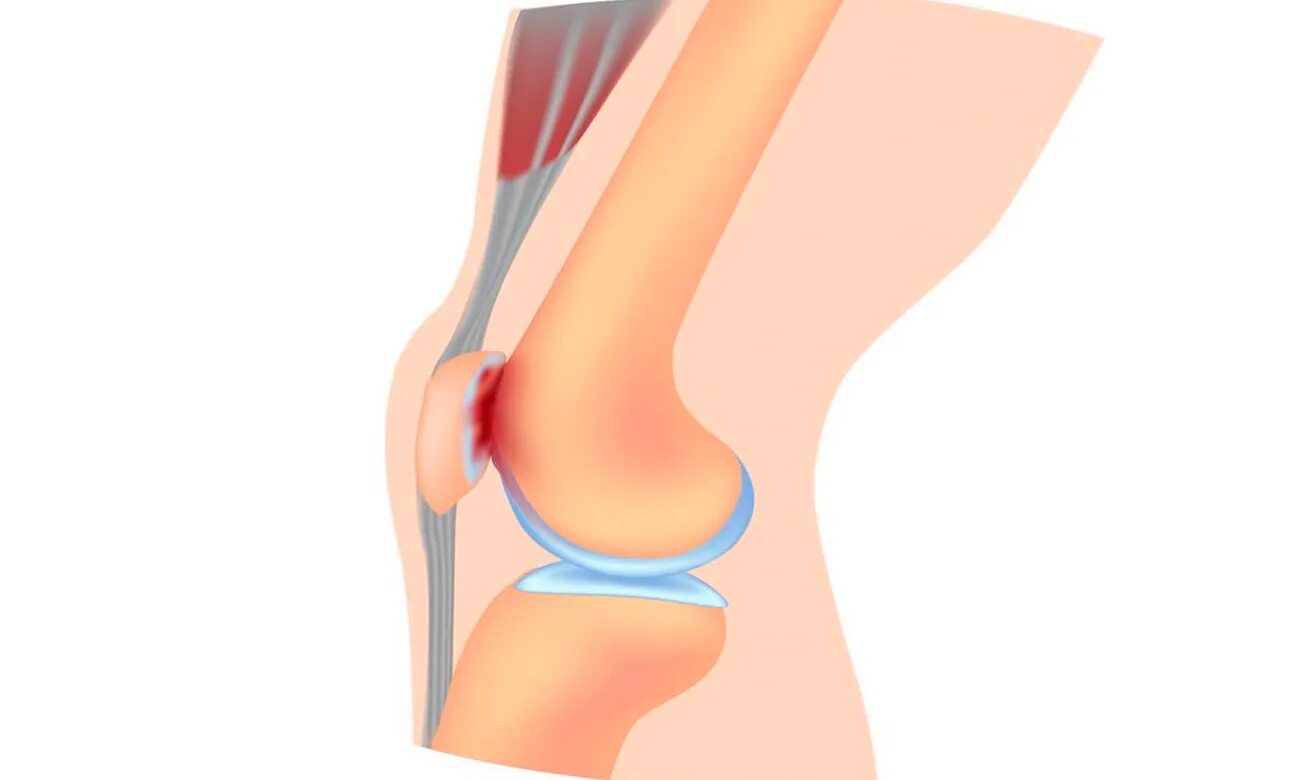 Хондромаляция медиальных мыщелков 4. Хондромаляция надколенника коленного сустава. Хондромаляция надколенника хондромаляция надколенника. Хондромаляция коленного сустава что это. Хондромаляция коленного хряща.