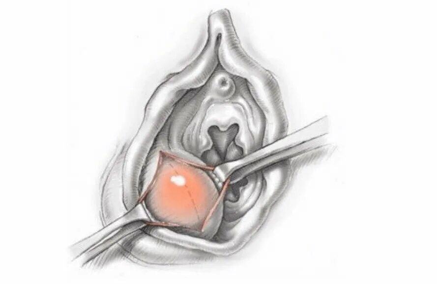 Катетер бартолиновой. Воспаление бартолиновой железы. Кистабартоливойжелезы. Киста бартолиновой железы. Вскрытие абсцесса бартолиновой железы.