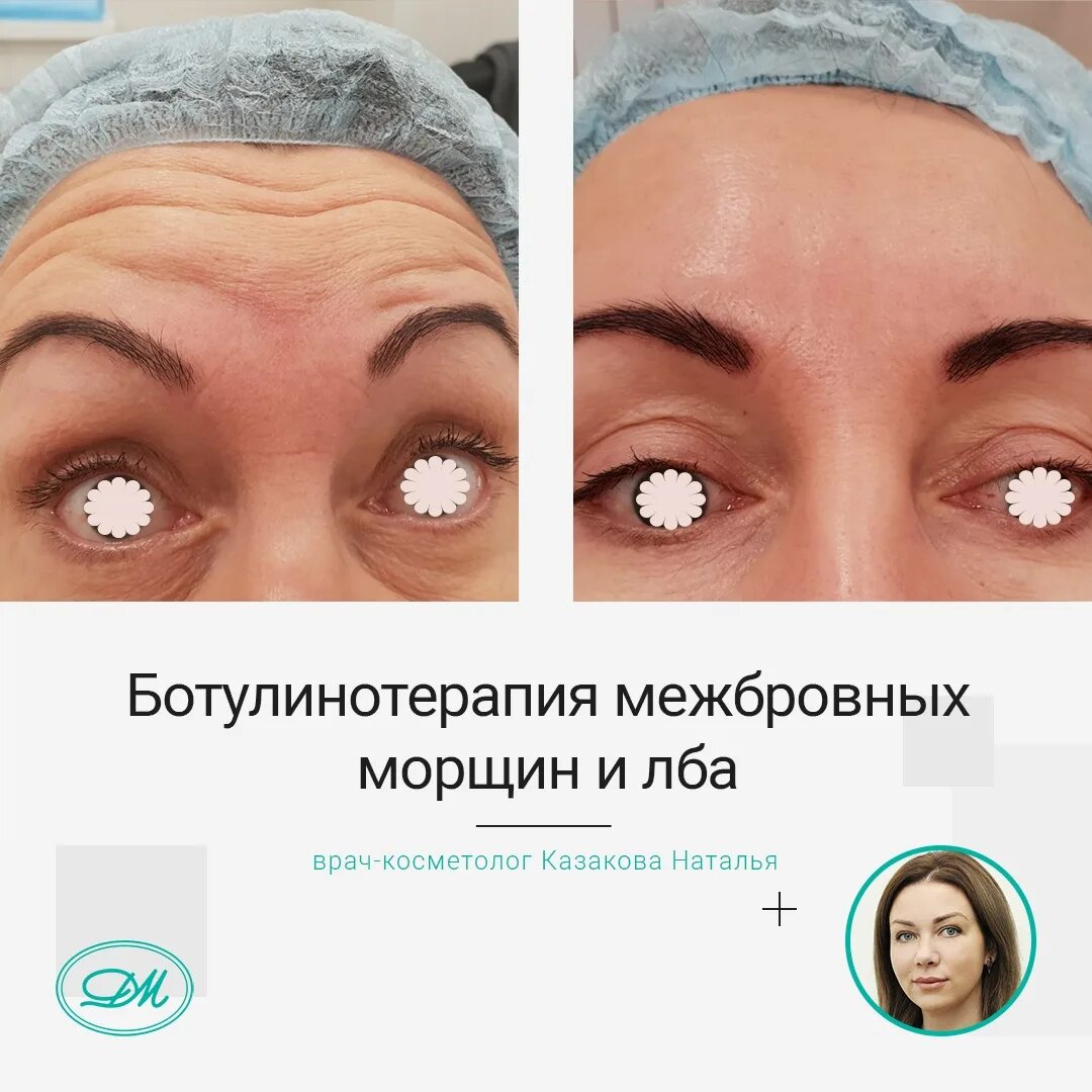 Сколько единиц ботокса в межбровье. Инъекции ботокса в межбровье. схемы введения диспорт в межбровье. упражнения от межбровных морщин.