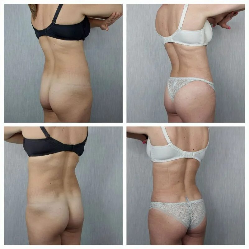 липосакция и липофиллинг ягодиц. липосакция и липофилинг. липоскульптурирование тела киров. липосакция и липофилинг. липосакция и липофилинг.