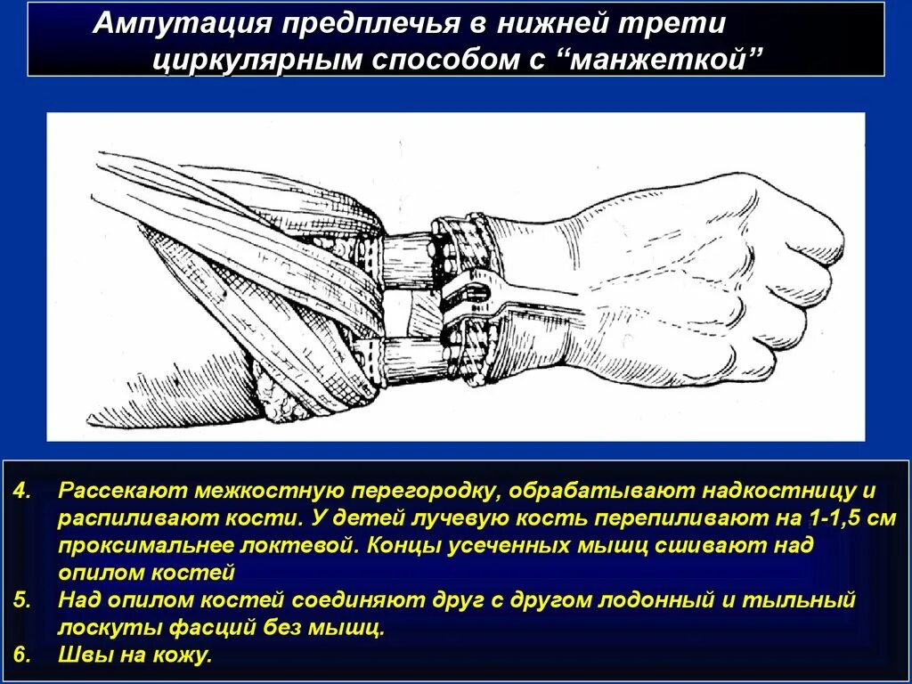 Ампутация предплечья в нижней трети. Экзартикуляция пальца стопы ход операции. Экзартикуляция лучезапястного сустава. Ампутация верхней конечности.