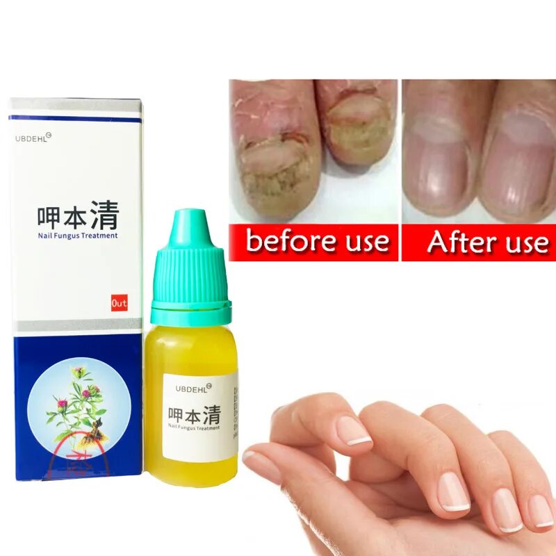 Набор для лечения ногтей. Китайское средство от грибка fungal Nail treatment. Китайский крем от грибка ногтей Nail fungus. Китайские капли от грибка ногтей. Спрей от грибка ногтей на руках.