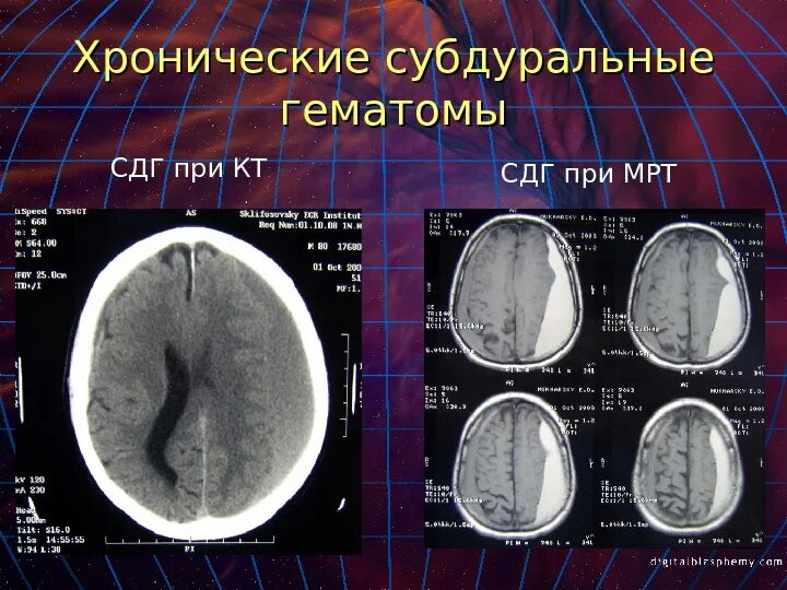 Черепно мозговые гематомы. Подострая субдуральная гематома на кт. Пластинчатая субдуральная гематома кт. Хроническая субдуральная гематома на кт. Субдуральная эмпиема кт.