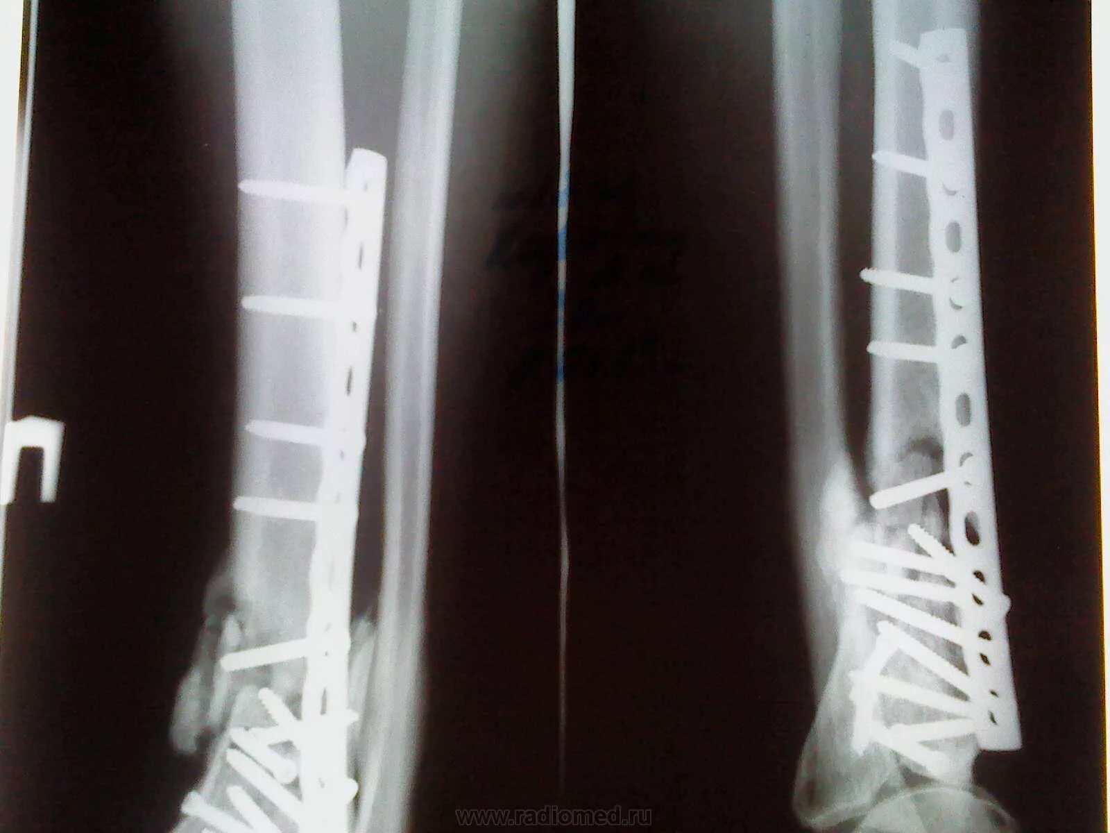 Остеосинтез перелома берцовой кости. Перелом большеберцовой кости остеосинтез. Перелом голени рентген остеосинтез. Остеосинтез перелома костей голени.